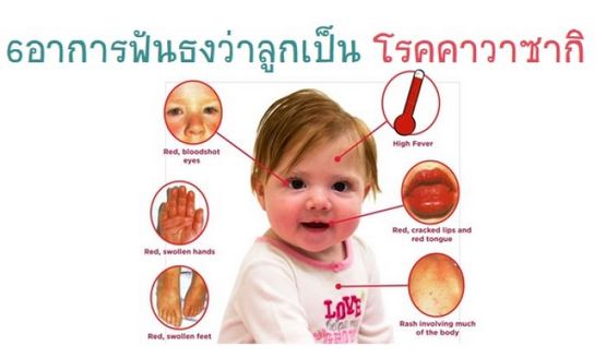 อาการของโรคคาวาซากิในทารก
